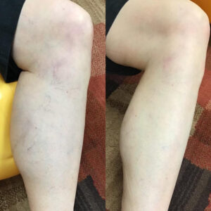 left leg: before and after
