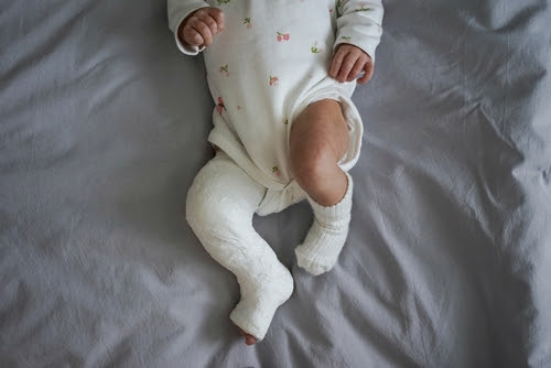 baby with leg/foot cast