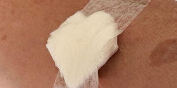 recovering after a blood draw