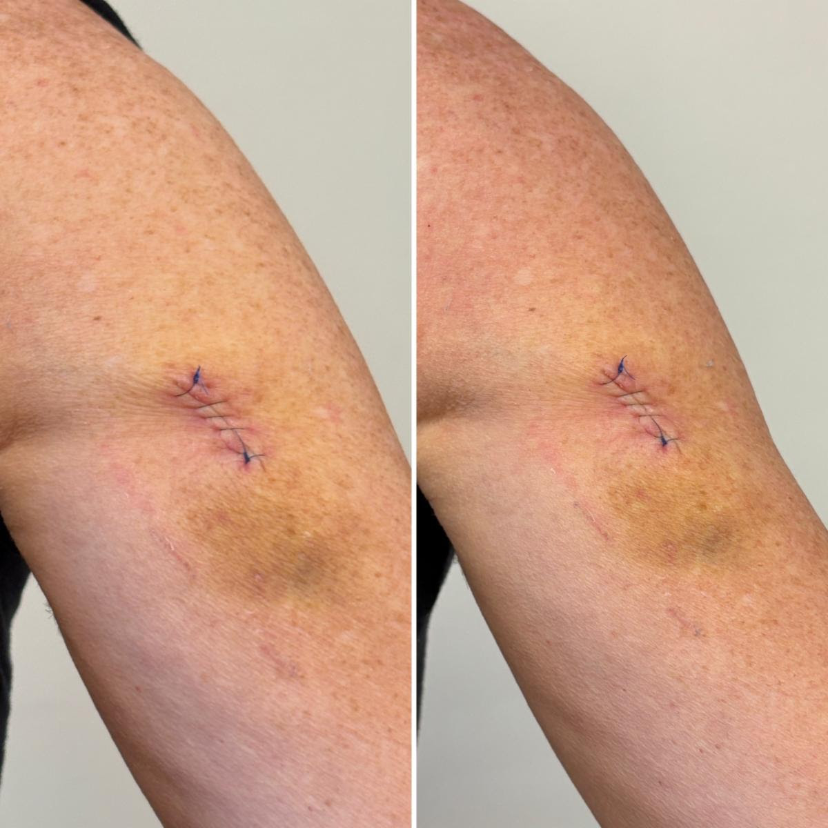 skin procedure scar