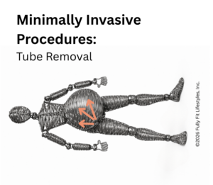 tube removal